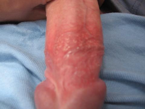 Vyrážky na kožke penisu